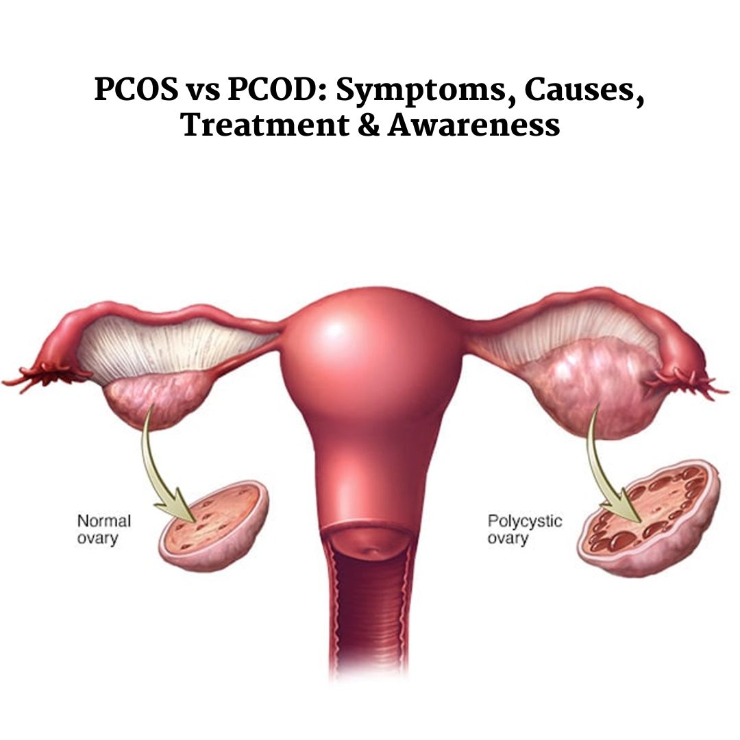 Infographic showing key differences between PCOS vs PCOD in symptoms, causes, and treatment